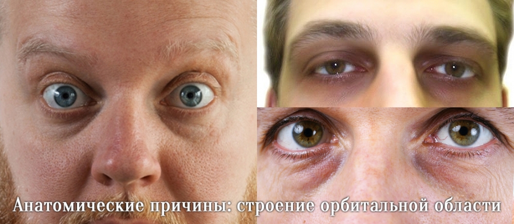 Наследственные синяки вокруг глаз