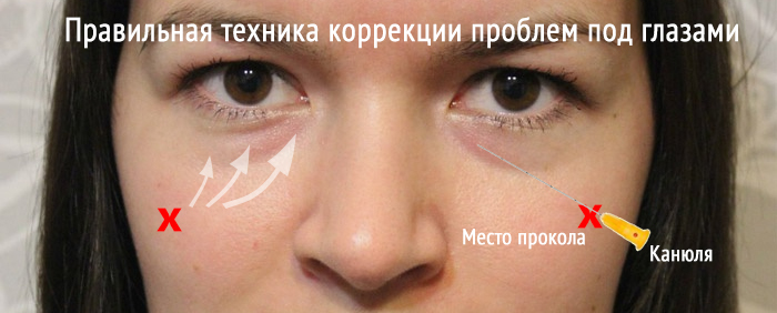 Как убрать мешки под глазами без операции - клиника Би Лучче Новосибирск
