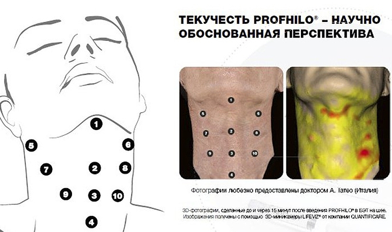 Инъекции для увлажнения кожи лица thumbnail