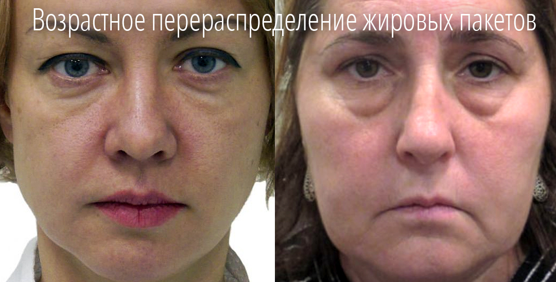 Липолитики для лица до и после фото под глазами