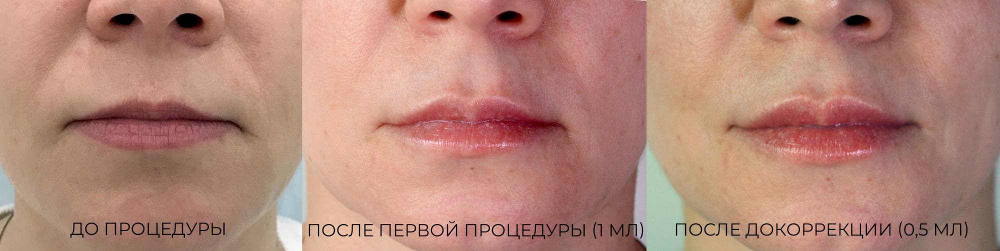 Коррекция формы и увеличение губ