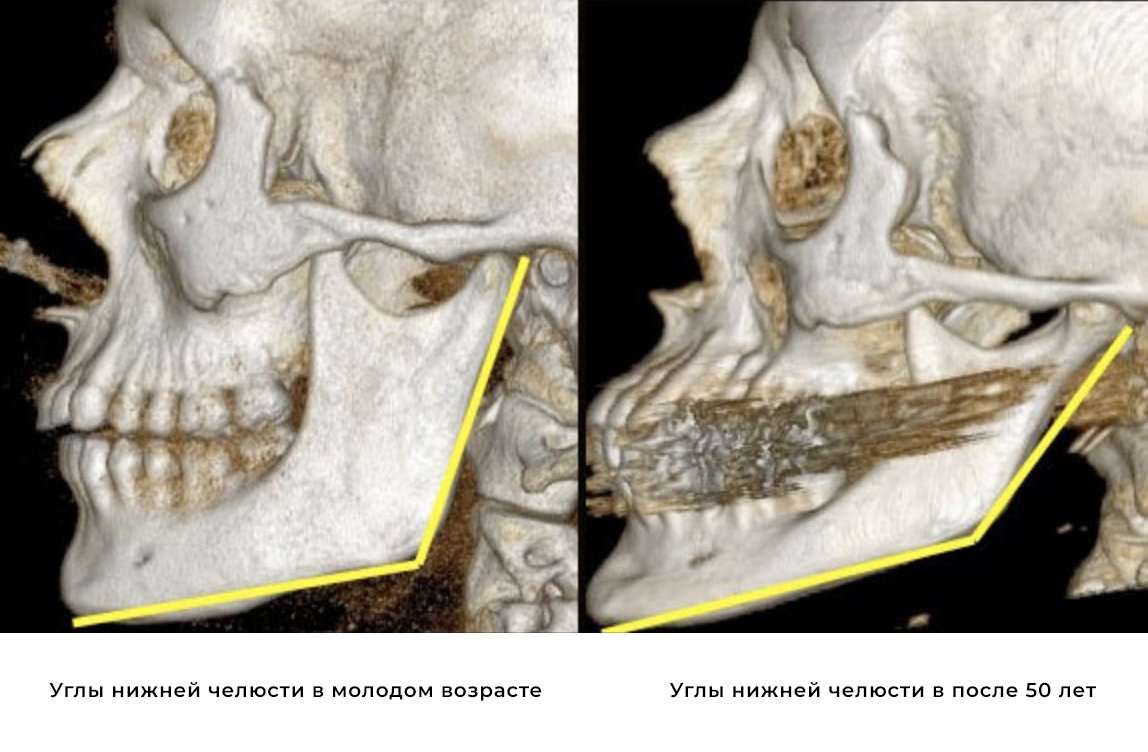 Костные ткани черепа. Резорбция костей челюсти. Резорбция костей лицевого черепа. Резорбция костной ткани верхней челюсти.