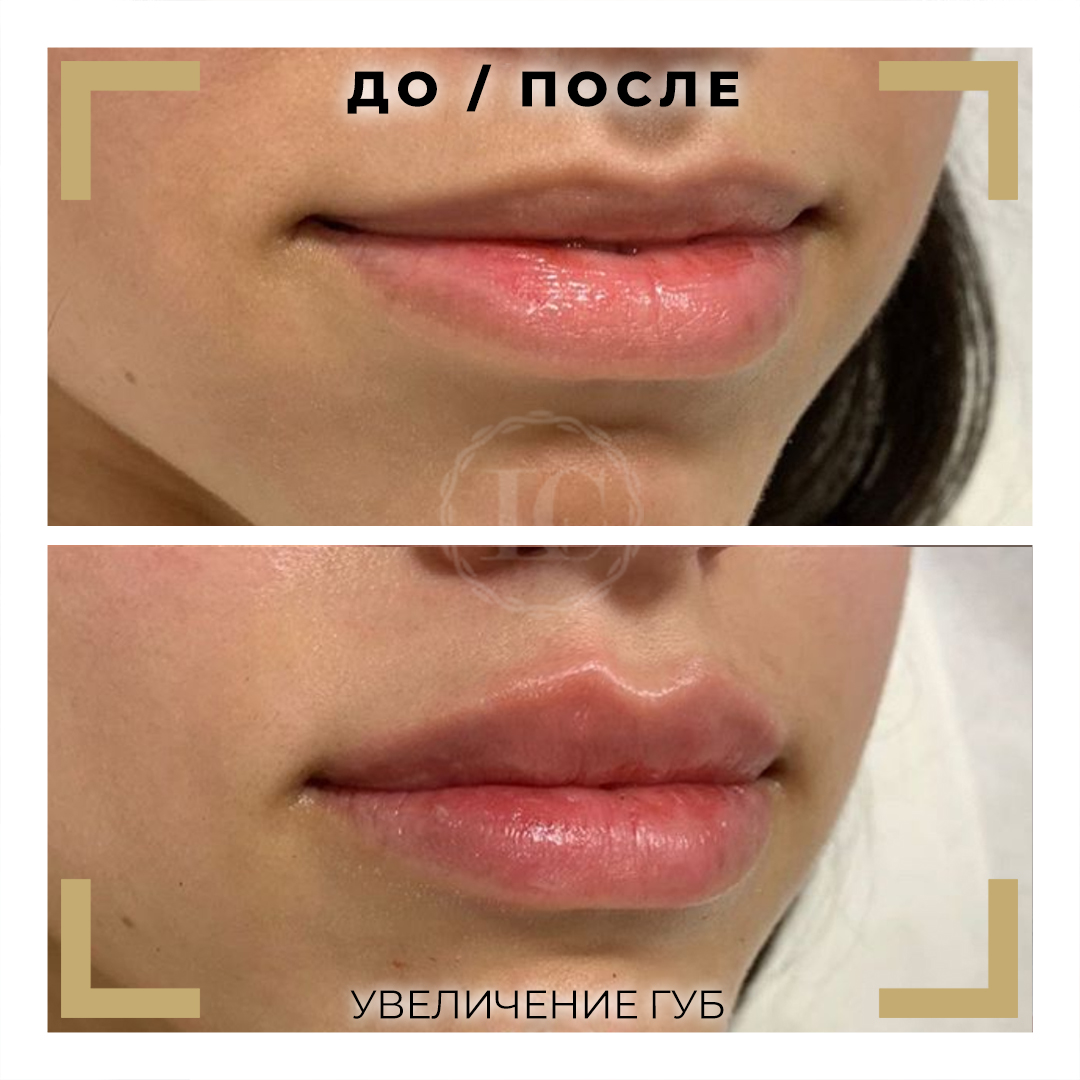 Увеличение губ гиалуроновой кислотой в Самаре по доступной цене | клиника косметологии Skinerica